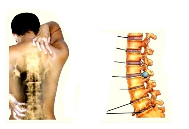 Osteohondrozes attīstības posmi