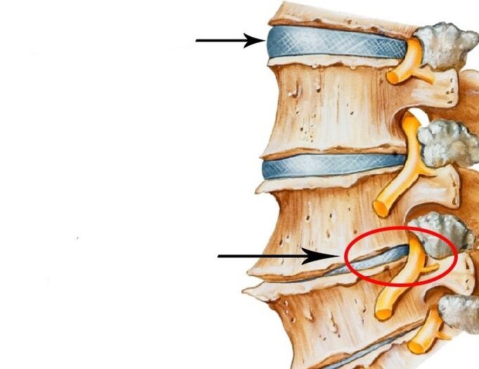 bojāts disks un pārkāpts nervs ar dzemdes kakla osteohondrozi