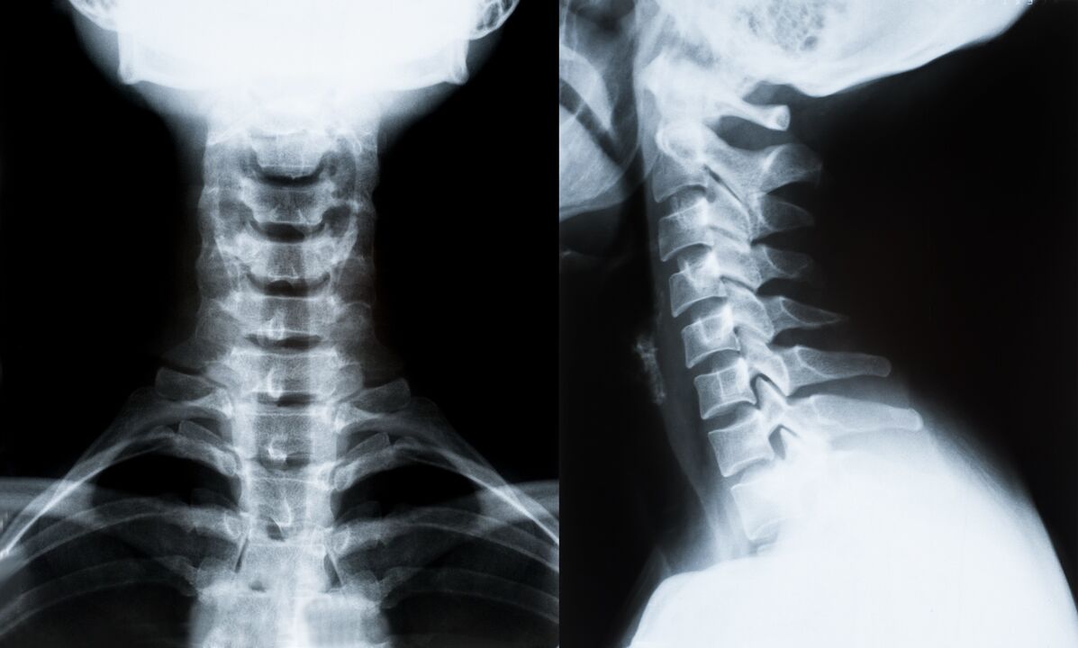 dzemdes kakla osteohondroze uz rentgena