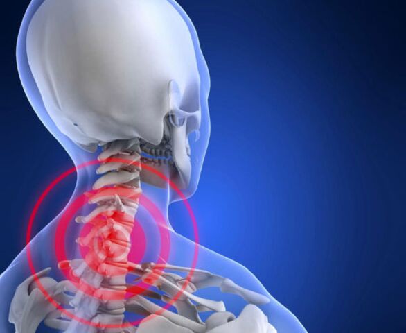 mugurkaula kakla daļas osteohondroze