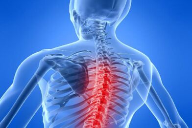 Muguras smadzeņu saspiešana krūšu kurvja osteohondrozē